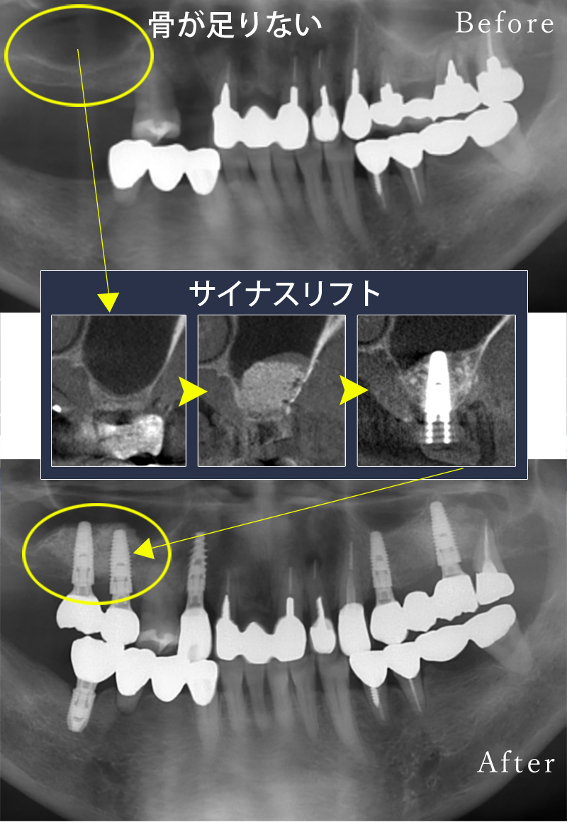 インプラント症例2